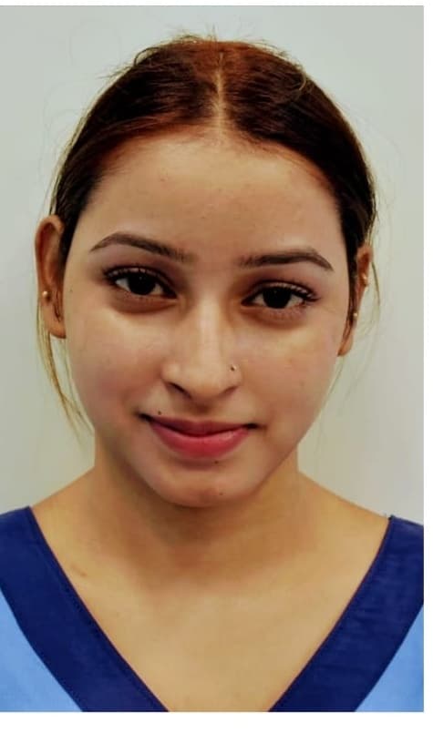Chemical Peel Medifacial — after
