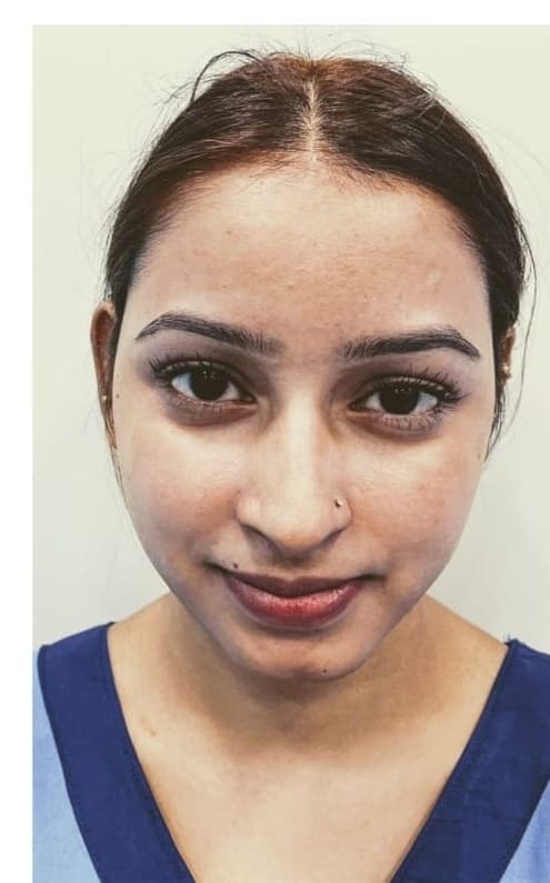 Chemical Peel Medifacial — before