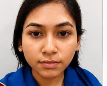 Hydra Facial — after
