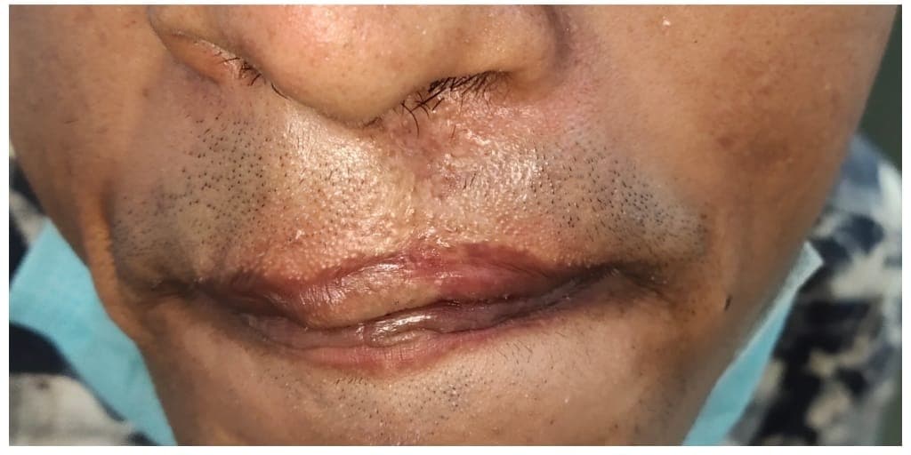 Scar Treatment — after
