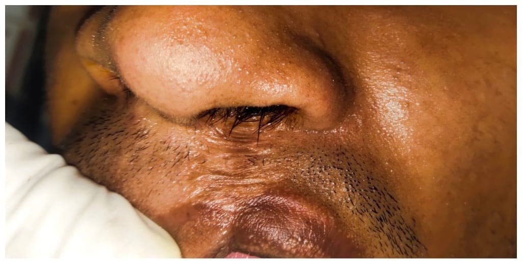 Scar Treatment — before